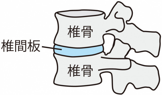 腰椎椎間板ヘルニアとは?