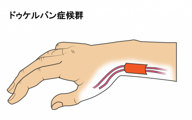 ばね指とは?