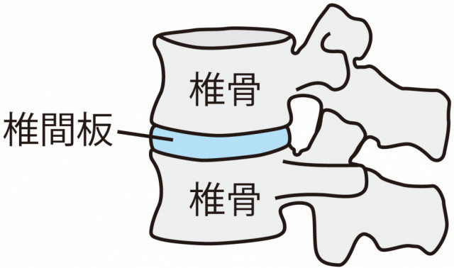 腰椎すべり症とは?